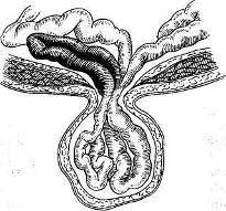 Хирургия грыж брюшной стенки - any2fbimgloader20.jpeg