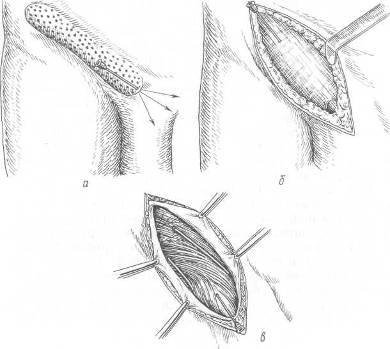 Хирургия грыж брюшной стенки - any2fbimgloader65.jpeg