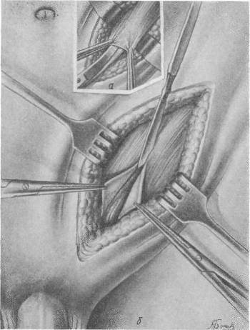 Хирургия грыж брюшной стенки - any2fbimgloader66.jpeg