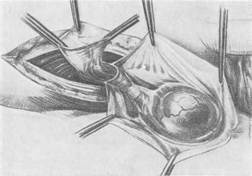 Хирургия грыж брюшной стенки - any2fbimgloader67.jpeg