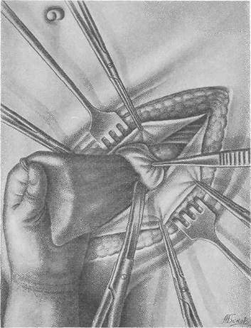 Хирургия грыж брюшной стенки - any2fbimgloader68.jpeg