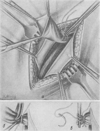 Хирургия грыж брюшной стенки - any2fbimgloader69.jpeg