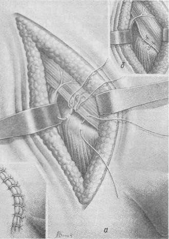 Хирургия грыж брюшной стенки - any2fbimgloader113.jpeg