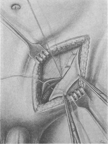 Хирургия грыж брюшной стенки - any2fbimgloader71.jpeg