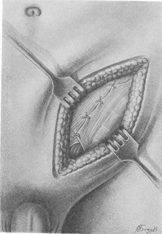 Хирургия грыж брюшной стенки - any2fbimgloader72.jpeg