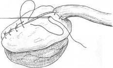 Хирургия грыж брюшной стенки - any2fbimgloader77.jpeg