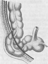 Хирургия грыж брюшной стенки - any2fbimgloader84.jpeg