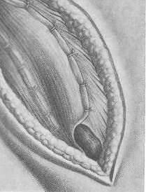 Хирургия грыж брюшной стенки - any2fbimgloader91.jpeg