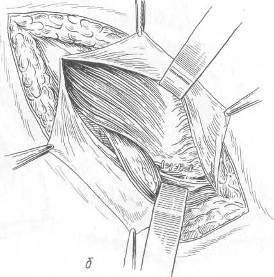 Хирургия грыж брюшной стенки - any2fbimgloader93.jpeg